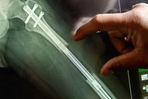 جراحی کوتاه کردن پا؛ چرا زنان حاضرند برای این عمل طاقت‌فرسا هزینه‌های سنگین بپردازند؟