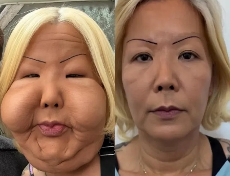 جراحی ترمیم چهره اینفلوئنسر معروف برزیلی پس از عمل زیبایی ناموفق